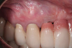 Fig 8. At 3.5 years,
treated sites were healthy and soft-tissue
changes were evident.