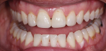 Comparison of pre- and postoperative retracted, full mouth views.