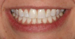 Pretreatment and posttreatment smile views, demonstrating muscle strain and relaxed lips, respectively.