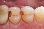 Occlusal view of the prepared teeth.