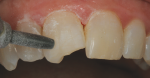 Micro air abrasion was performed to clean the tooth and remove the aprismatic enamel surface to increase mechanical retention.