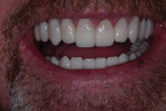 Close-up smile photograph of the milled provisional restorations with teeth apart.