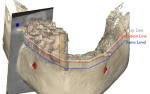 Fig 12 through Fig 14. By merging the photograph showing the patient speaking, intraoral scan, and CBCT scan of the mandible, the planning of implant placement in the mandible was started.