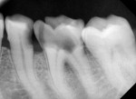 Fig 2. Intraoral periapical radiograph showing perforation on the pulpal floor of the mandibular left first molar.