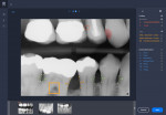 Fig 6. A bitewing radiograph with AI annotations to support dentist communication with the patient is shown. Findings include but are not limited to caries, compromised margins, bone level, and furcation involvement. (Source: Overjet, Inc.)