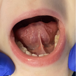 Fig 1. Posterior tongue-tie causing restricted tongue mobility. This degree of restriction often can lead to symptoms of speech, feeding, or sleep difficulty in a child. If a restriction is noted, the patient should be screened for common symptoms to determine if it is limiting the child or affecting quality of life.