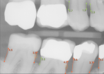 Fig 3. The following image illustrates periodontal insights from AI radiographic assessment. Bone levels marked in red indicate potential areas of radiographic bone loss as measured from the CEJ to crest of bone. Calculus is detected automatically and highlighted with the orange box. In addition to perio charting, the “periodontal health” of a practice can now be assessed and quantified. (Source: Overjet, Inc.)
