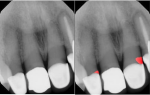 Fig 4. Detection of defective margins around prosthetic restorative materials is
shown. In the image on the right, defective margins are identified in red on teeth Nos. 7 (ceramo-metallic crown) and 9 (ceramo-metallic crown). (Source: Overjet, Inc.)