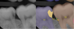 Fig 5. Class 2 caries detection on a posterior radiograph  is shown. In the image on the right, the carious lesion is masked in yellow on tooth No. 19. Additional tooth numbering AI models and bone level models are also being run and results displayed in this image. (Source: Overjet,
Inc.