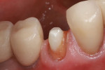 Buccal view of the completed crown preparation.