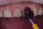 At the start of the appointment, any existing restorative material was removed from the teeth and they were thoroughly cleansed with pumice. Next, the alternating teeth to be restored in the first round of injections were individually etched and bonded. Avoiding etching and bonding the adjacent teeth in order to be able to separate them after the first round is more important in cases involving wide contact points, such as the those for the full coverage “injection crowns” in this case.