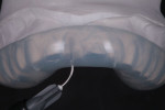 View of the first matrix placed on the model demonstrating placement of the injection tip. To avoid the formation of bubbles, it is important to insert the tip as far cervical as possible before starting to inject, and then slowly withdraw the tip while injecting.
