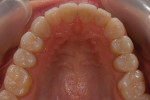 Postoperative maxillary occlusal view of the upper arch showing that all eroded surfaces are protected.