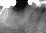 Fig. 16. Radiograph demonstrated socket healing and graft incorporation with the surrounding host bone at 6 months post-surgically, indicating that the site was ready for implant placement.