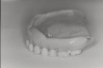 Fig. 1 and Fig. 2. These images indicate the possibility of the need for relining or remaking a new denture. Note the plaque accumulation.