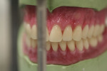 Fig. 3. Wax is missing between Nos. 9 and 10 and at the point of contact between Nos. 8 and 9, making these areas vulnerable to food accumulation. Note also stippling, which makes it difficult to maintain a clean denture.