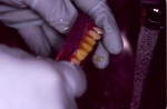 Fig. 7. To minimize food debris accumulation and staining, the entire denture should be cleaned using a non-abrasive liquid soap and soft-bristle toothbrush.