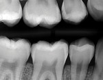 Comparison of the initial pretreatment bitewing radiograph and the posttreatment 6-month follow-up bitewing radiograph, showing proximal radiolucencies and the development of an open margin in the gingival floor of the Class II resin based composite restoration.