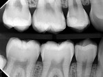 Posttreatment 13-month bitewing radiograph showing insignificant progression of the radiolucencies and possible remineralization in some areas.