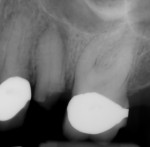 Pretreatment radiograph of tooth No. 13.