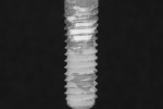 Fig 4. Cement assessed as being moderately removed from SLA surface by Ti curet. Cement was removed from the crest of the implant threads. As with other surfaces treated with the Ti curet, while some cement was removed between the threads, minimal exposure of the implant surface was achieved.