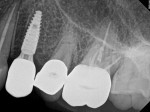 Fig 7. Periapical radiograph of No. 12 titanium abutment and screw-retained zirconia crown.