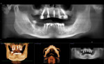 Postoperative CBCT scan showing the five maxillary implants in place retaining the immediate provisional hybrid prosthesis.