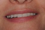 Fig 30. The patient’s smile at 2.5 years post-implant placement. Note low lip line and low gingival display.