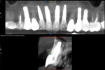 Fig 31. CBCT slice No. 8 at 2.5 years post-implant placement (September 26, 2019); 2 mm buccal thickness was maintained with the use of slowly resorbing biomaterial.