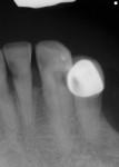 Fig 3. Radiograph demonstrated interproximal caries on the incisors and tooth No. 22 with no apical pathology noted. The area on the distal of No. 21 was non-probable with an explorer, and all teeth tested negative to percussion and hot/cold.