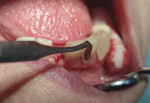 Fig 9. The other preparations were filled in
a similar manner with a DiaFil Flow liner and overlaying DiaFil nanohybrid composite prior to the restorations being lightcured.