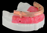 Fig 7. After the confirmation of functional and esthetic outcomes of the maxillary interim hybrid prosthesis, a titanium substructure was designed and manufactured using the interim prosthesis as a reference.
