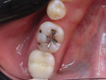Preoperative occlusal view of tooth No. 30 showing three failing amalgam restorations.