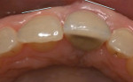 Fig 2. Occlusal aspect showing a labial position of the implant restoration.