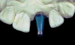 Fig 15. Implant in the center of the cast alveolar socket with an overcontoured buccal profile.