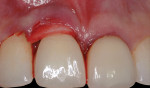 Fig 27. Alloderm membrane plugged into the tunnel above the implant restoration.