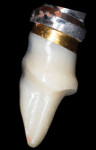 Fig 33. Initial new implant abutment with a subtle concave emergence/platform switching.
