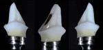 Fig 35. New hybrid implant abutment: titanium and zirconia.