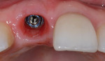 Fig 40. New peri-implant soft-tissue emergence profile with increased thickness of the buccal gingiva.