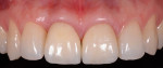 Fig 48. Final photograph in April 2015 showing uniformity in gingival margins induced by gingival memory after orthodontic treatment.