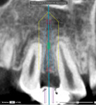 Fig 50. CBCT of Nos. 6, 7, and 8, showing apical root proximity.
