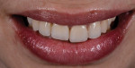 Fig 20. Patient smile with a low lip line, 18 years after restoration, January 2014.