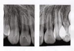 Pretreatment radiographs of the maxillary right and left lateral incisors.