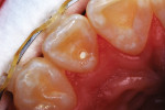 Occlusal view of the preparation following light curing of the bonding agent.