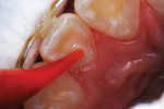 A bioactive composite restorative material was injected until overfill.
