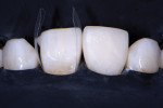 Following shaping of tooth No. 8, the matrices were placed to restore tooth No. 9.