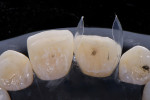 Palatal view showing insertion of the matrices into the rubber dam to create a cervical seal. The occlusion was marked prior to isolation, and the marks were preserved to facilitate fast shaping back to the original position.