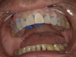 The facial surfaces of teeth Nos. 6 through 11 were prepared by gently sandblasting them with a 27-μm aluminum oxide powder, then they were etched with a 35% phosphoric acid solution for 20 seconds.