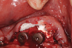 Fig 4. The 4-mm-thick pieces of VSCM were placed over the collagen membranes and under the buccal flap extending from sites Nos. 20 through 29.