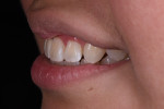 Fig 15. Final smile, left lateral view.